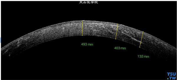 格子状角膜营养不良，同一患者，右眼RTvue OCT检查，可见角膜基质条索状密度不均的影像，角膜上皮层欠光滑