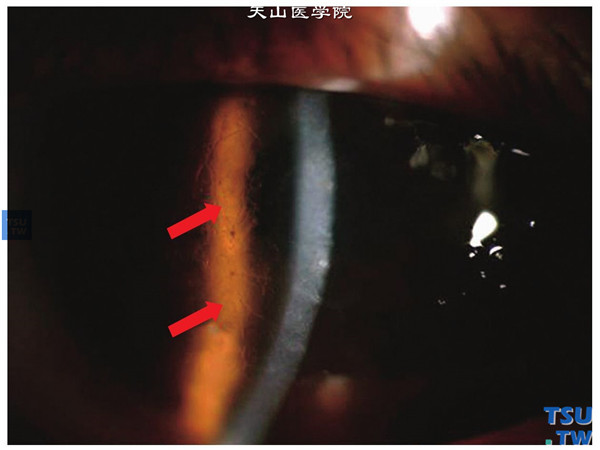 格子状角膜营养不良，同一患者左眼，角膜变性局部表现同右眼相似