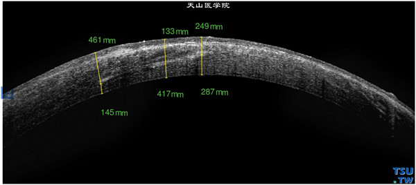 格子状角膜营养不良，左眼RTvue OCT检查，可见角膜基质条索状密度不均的影像，角膜上皮层欠光滑