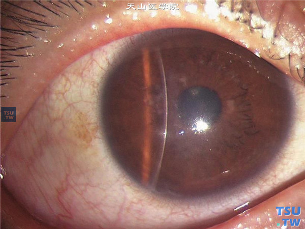 格子状角膜营养不良，随着病情进展，格子状混浊互相融合，累及角膜中央区，视力受损