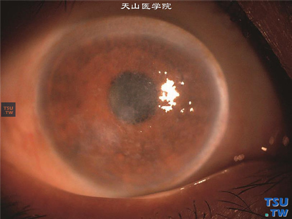 格子状角膜营养不良，角膜基质层有弥漫性格子样损害，视力受损