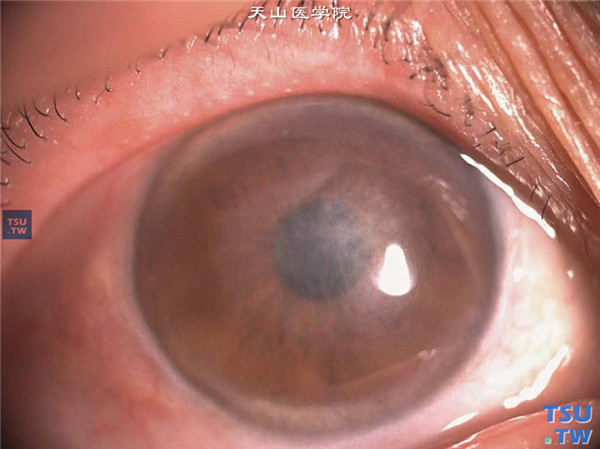 云片状角膜营养不良，右眼结膜轻度充血，角膜基质层有云片状混浊，视力受累