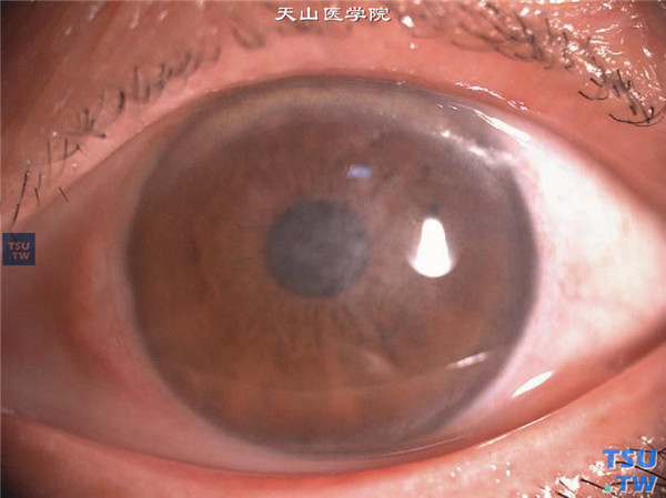 云片状角膜营养不良，同一患者左眼，结膜轻度充血，角膜基质层同样发生云片状混浊，视力受累