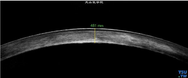 云片状角膜营养不良，左眼 RTvue OCT 检查，显示角膜基质层影像密度增高，深基质层明显，上皮层完整，角膜厚度基本正常