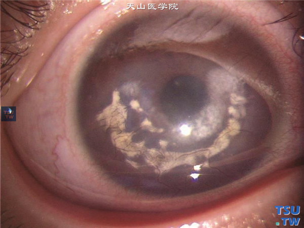 云片状角膜营养不良，右眼角膜基质如鳄鱼皮样片状混浊，伴随有新生血管，但视轴区角膜仍保持透明
