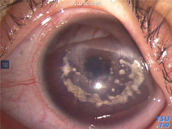 云片状角膜营养不良，同一患者左眼，角膜基质层混浊同右眼相似