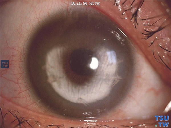 云片状角膜营养不良，右眼角膜基质层混浊，融合成半环形，但视轴区角膜仍保持透明