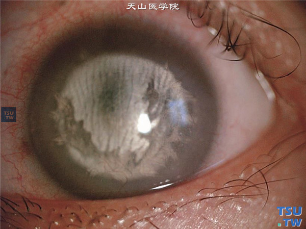 云片状角膜营养不良，同一患者，左眼混浊区融合成大片片状混浊，中央区角膜也发生混浊，伴有角膜深部新生血管长入