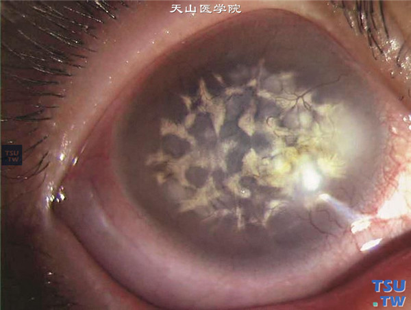 云片状角膜营养不良，有些患者表现为角膜基质层浓密的混浊，伴有新生血管，视力严重受损
