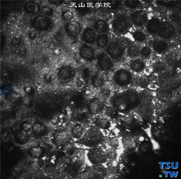 Fuchs角膜内皮细胞营养不良，同一患者，临床共聚焦显微镜检查，角膜内皮细胞形态极不规则，细胞大小不一，可见病理性黑区 ×800