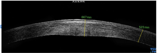 Fuchs角膜内皮细胞营养不良，同一患者，RTvue OCT检查，显示角膜基质水肿、增厚，内皮层粗糙，可见细点状密度不均的影像