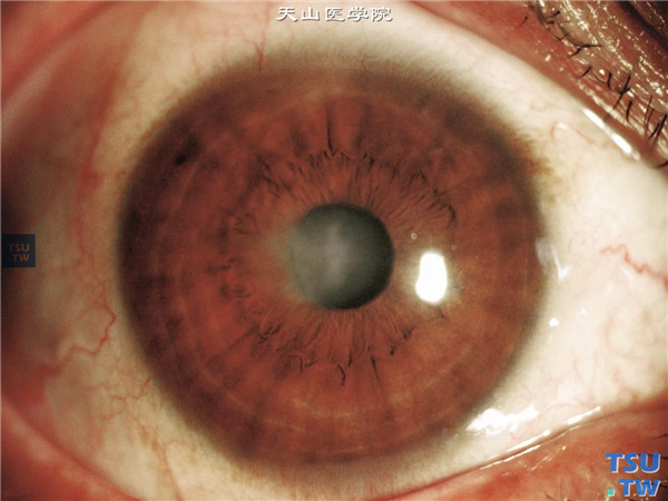 Fuchs角膜内皮细胞营养不良，同一患者，右眼中央区角膜基质混浊