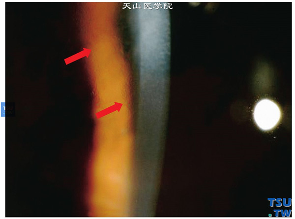 Fuchs角膜内皮细胞营养不良患者，右眼裂隙灯显微镜检查，可见角膜内皮面多发性赘疣，间接照明法检查，角膜后有橘皮样外观