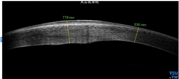 Fuchs角膜内皮细胞营养不良患者，右眼RTvue OCT检查，可见角膜基质水肿，明显增厚，内皮层影像欠完整和光滑