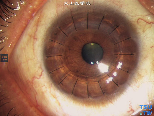 Fuchs角膜内皮细胞营养不良患者，右眼角膜内皮显微镜检查，内皮面成像不清，无法计数，行穿透角膜移植术，术后随访1年，角膜植片透明