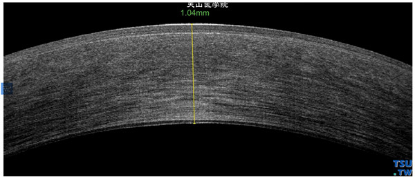 Fuchs角膜内皮细胞营养不良，同一患者，RTvue OCT检查，显示角膜基质水肿，增厚，上皮层和内皮层也有不同程度的增厚