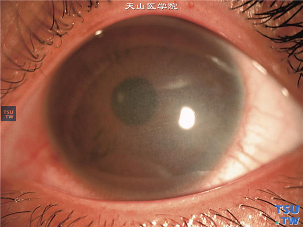 Fuchs角膜内皮细胞营养不良患者，同一患者左眼，裂隙灯显微镜大体观同右眼，中央区角膜雾状混浊
