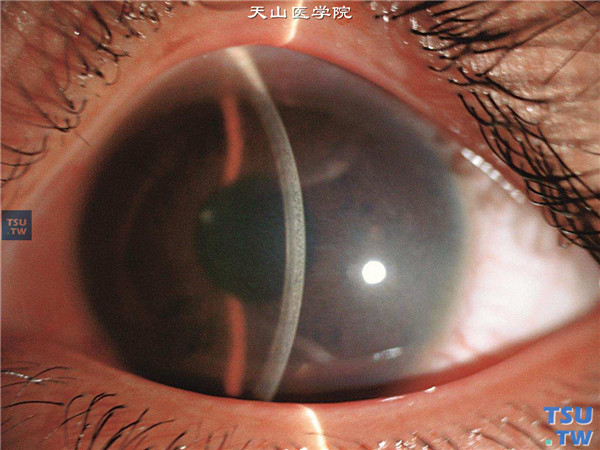 Fuchs角膜内皮细胞营养不良患者，左眼裂隙灯显微镜检查，可见角膜基质弥漫性水肿，内皮层增厚和内皮面粗糙