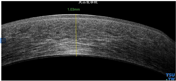 Fuchs角膜内皮细胞营养不良患者，，左眼RTvue OCT检查，可见角膜基质层水肿，明显增厚，上皮层和内皮层增厚，内皮层影像密度不均