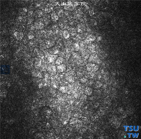 Fuchs角膜内皮细胞营养不良患者，左眼临床共聚焦显微镜检查，角膜内皮细胞形态极度不规则，细胞大小不均 ×800