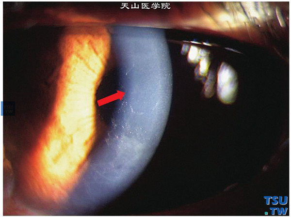 后部多形性角膜内皮细胞营养不良及症状图解