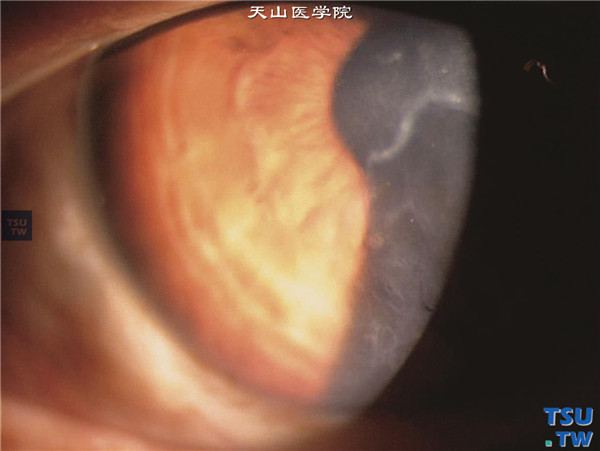 后部多形性角膜内皮细胞营养不良，上图同一患者，裂隙灯显微镜宽光带检查，可见角膜内皮面地图形分散的灰线