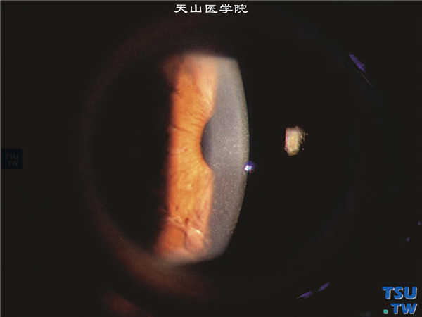 Chandle综合征，上图同一患者，裂隙灯显微镜检查，可见角膜后部改变如Fuchs角膜内皮细胞营养不良