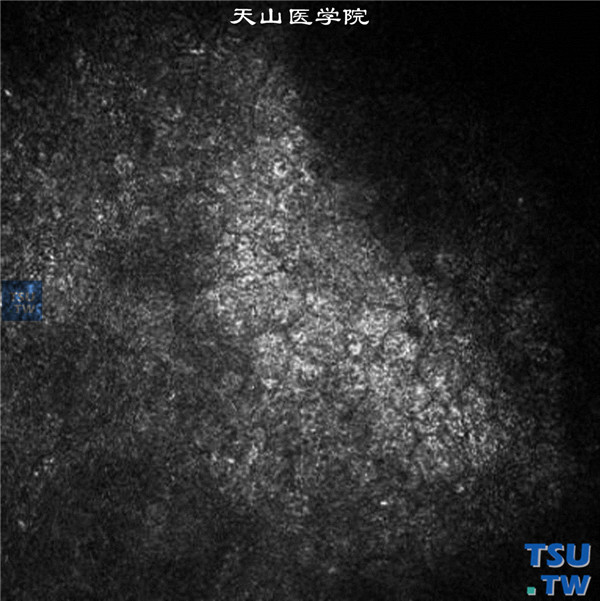 Chandle综合征，上图同一患者，临床共聚焦显微镜检查，可见角膜内皮细胞边界欠清，形态不规则 ×800