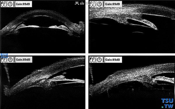 Chandle综合征，上图同一患者，超声生物显微镜检查，可见周边虹膜前膨隆、增厚和前粘连，相应房角变窄或关闭