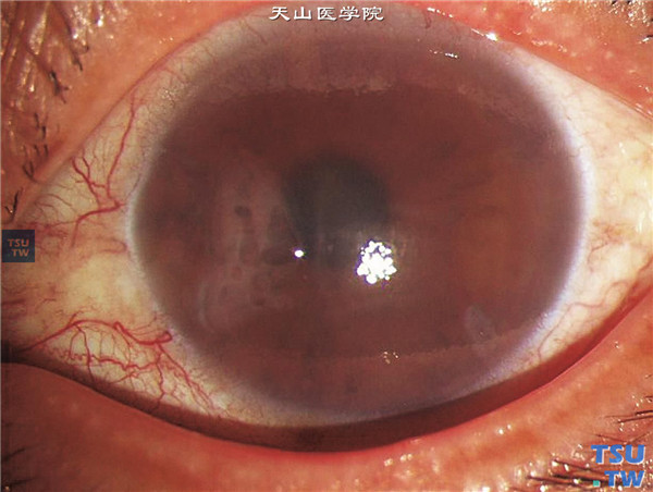 Chandle综合征，周边虹膜前粘连，眼压升高，角膜水肿