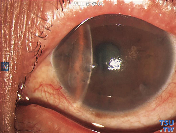 Chandle综合征，上图同一患者，裂隙灯显微镜检查，角膜基质弥漫性水肿，上皮下水泡