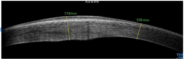 Chandle综合征，上图同一患者，RTvue OCT检查，可见角膜基质水肿、增厚，内皮界线粗糙，呈细点状密度不均的图像