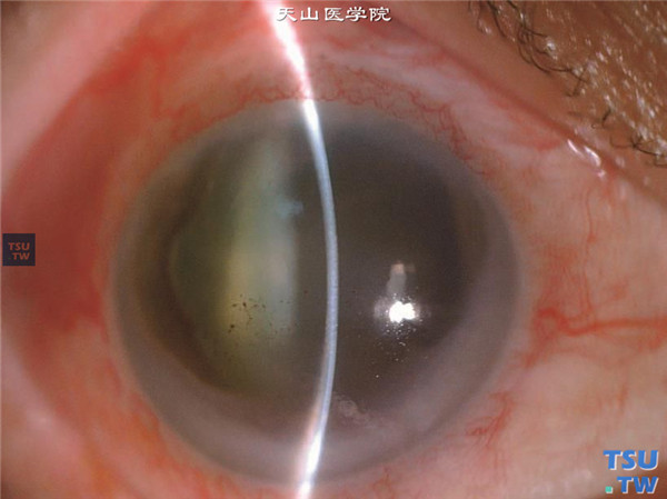 Chandle综合征，上图同一患者，裂隙灯显微镜检查，可见周边虹膜前粘连和角膜明显增厚，角膜内皮面可见多发性滴状赘疣