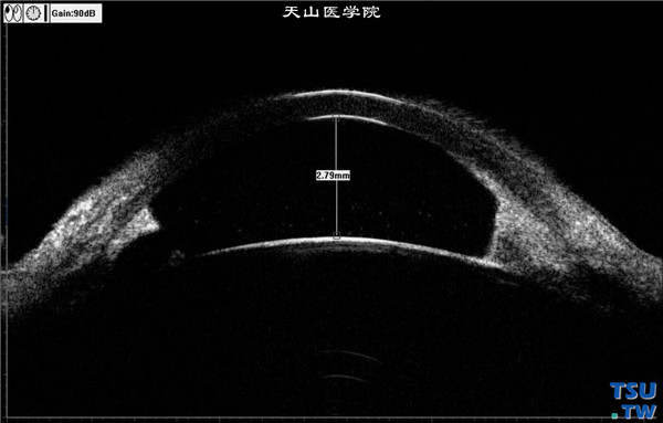 Chandle综合征，上图同一患者，超声生物显微镜检查，可见虹膜根部前粘连，房角关闭