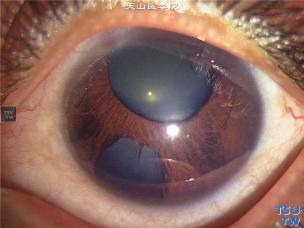 原发性进行性虹膜基质萎缩，虹膜萎缩变薄，发生裂孔，形成双瞳