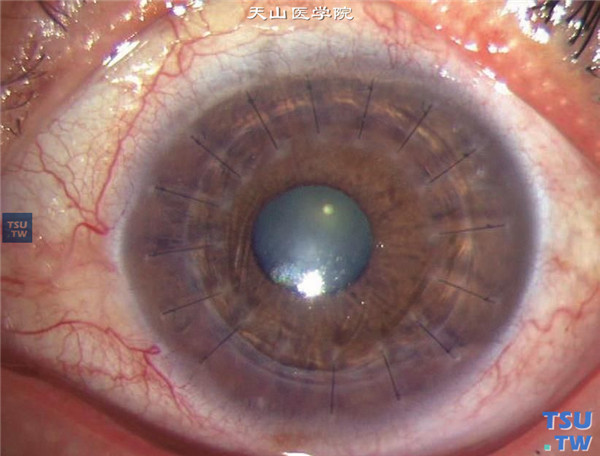 虹膜角膜内皮综合征，上图同一患者，行穿透角膜移植术，术后随访1年，角膜植片透明，眼压正常