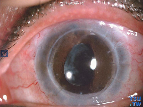 虹膜角膜内皮综合征，上图同一患者，行小梁切除术，术后随访1年，眼压正常，角膜植片透明