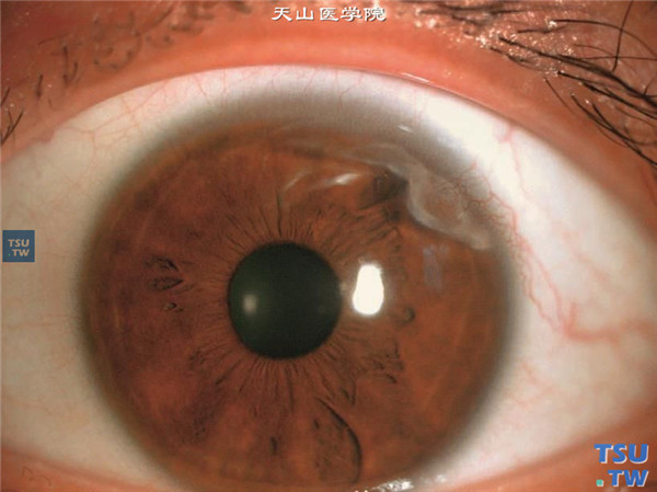 Terrien边缘变性，浸润变性期，上方1/4象限角膜缘有灰白色混浊，视力未受累