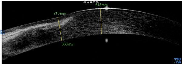 Terrien边缘变性，上图同一患者，RTvue OCT检查，显示病变区角膜浅基质层条状混浊，病变区角膜变薄，上皮层和内皮层完整