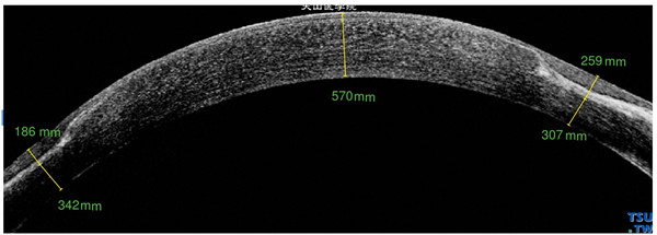Terrien边缘变性，上图同一患者，RTvue OCT检查，显示病变区角膜变薄，并在浅基质层有带状致密的影像