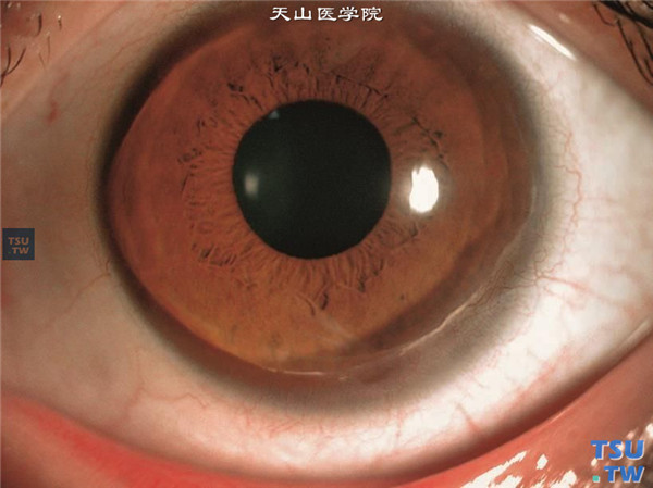 同一患者左眼，Terrien边缘变性，明显进入浸润变性期，近1/2圆周角膜缘组织有变性混浊，病变区伴随有新生血管