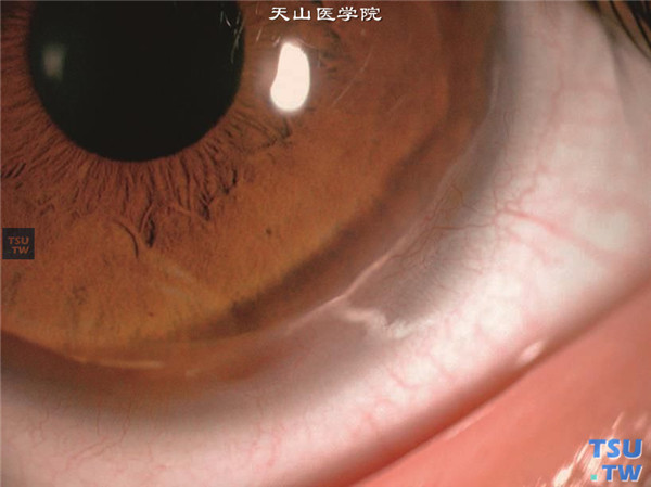 Terrien边缘变性患者，左眼裂隙灯显微镜检查，可见病变局部角膜混浊变薄，伴有新生血管长入