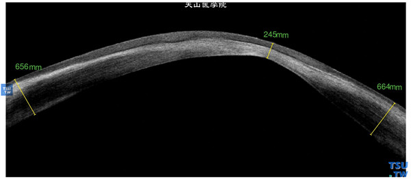 Terrien边缘变性患者，左眼RTvue OCT检查，病变区角膜基质层厚薄不均，角膜最薄处仅有245mm，上皮层和内皮层尚完整