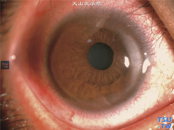 Terrien边缘变性，浸润变性期，右眼结膜充血，角膜缘呈灰白色浸润，新生血管长入，血管扩张