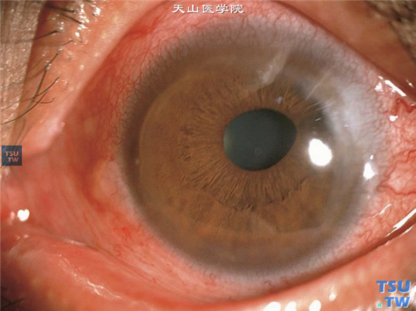 Terrien边缘变性，上图同一患者，左眼局部表现同右眼相似，结膜充血，病变区浸润加重，血管扩张，病变区部分虹膜前粘连，瞳孔变形
