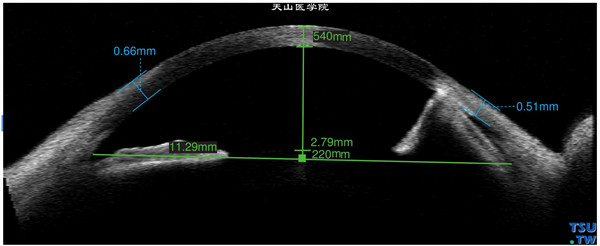 Terrien边缘变性患者，左眼Visante OCT检查，显示病变区除角膜变薄外，虹膜已有明显前粘连
