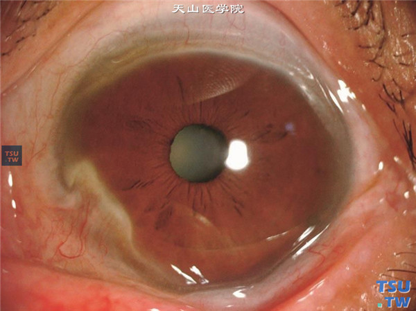 Terrien边缘变性，浸润变性期，病变区角膜混浊，有血管膜覆盖病变区，形成假性胬肉