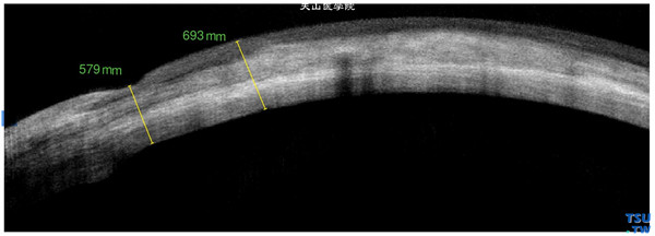 Terrien边缘变性，上图同一患者RTvue OCT检查，可见角膜病变区角膜变薄，病变区可见假性胬肉影像