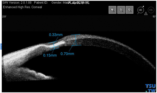 Terrien边缘变性，上图同一患者，Visante OCT检查，可见病变处角膜明显变薄，角膜基质层内有片状密度增高的影像