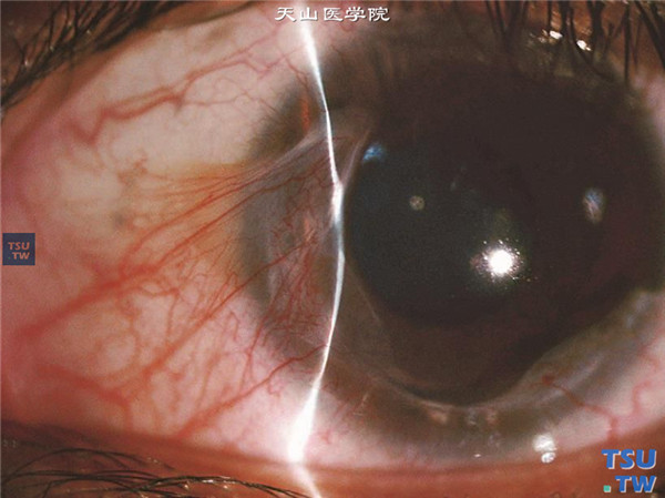 Terrien边缘变性，上图同一患者，裂隙灯显微镜检查，可见病变区角膜明显变薄和厚薄不均
